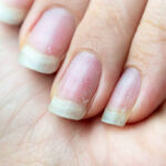Nail White Spots