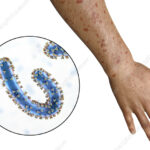 Marburg Virus