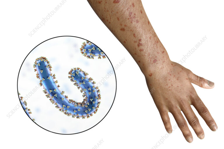 Marburg Virus