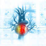 takotsubo cardiomyopathy