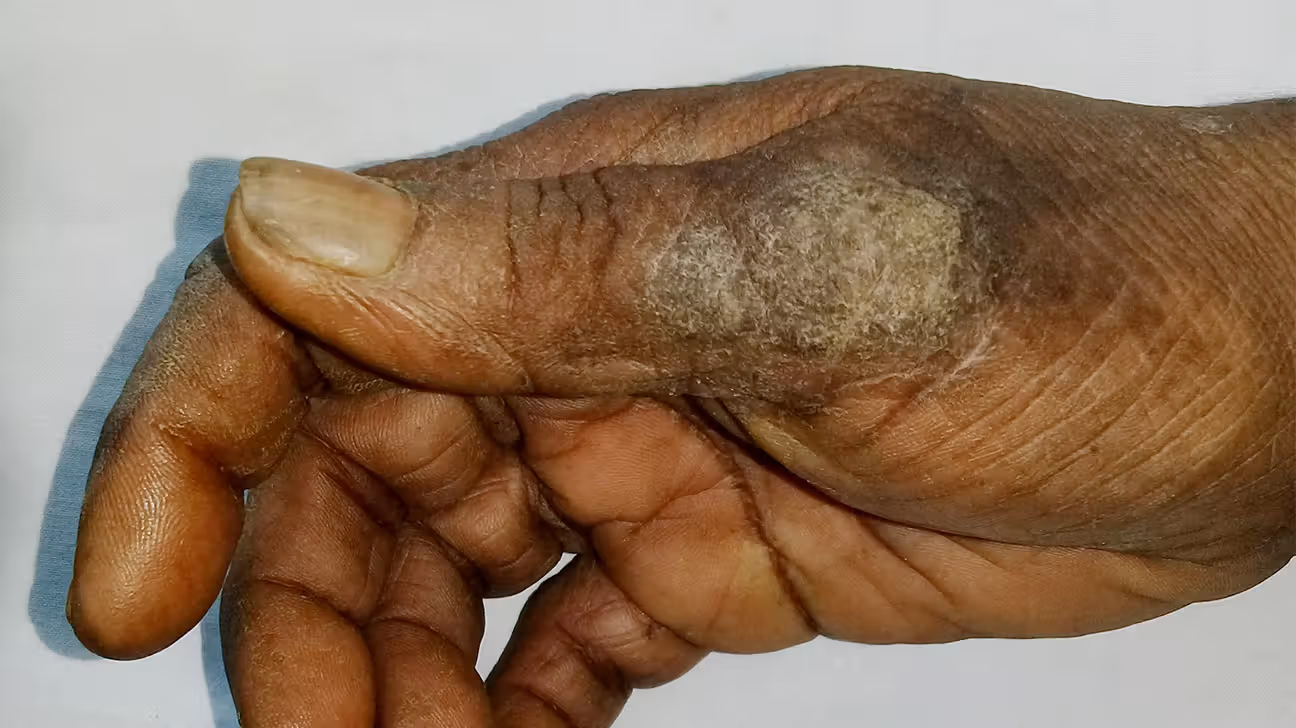 Example of Ringworms.