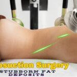 Liposuction Surgery