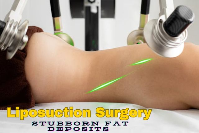 Liposuction Surgery